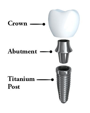 Three parts of a dental implant: Titanium post, abutment, and crown.